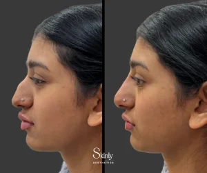 Before and after liquid rhinoplasty, showing refined nose contour.