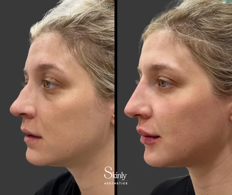 Before and after liquid rhinoplasty, showing refined nasal bridge.