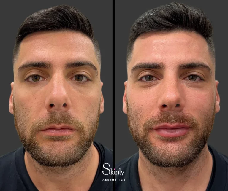 Male patient before and after lip filler showing improved lip shape.