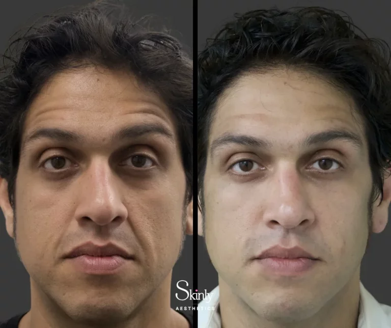 Male patient before and after nasolabial fold filler, showing smooth mid face creases.