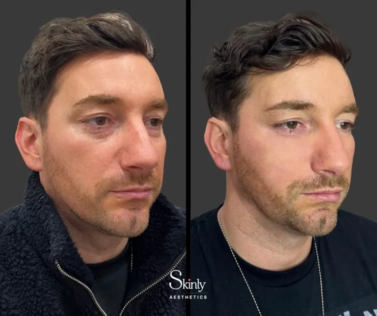 Male patient before and after under eye filler, showing diminished dark circles.