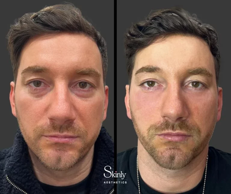 Male patient before and after under eye filler, showing rejuvenated under eyes.