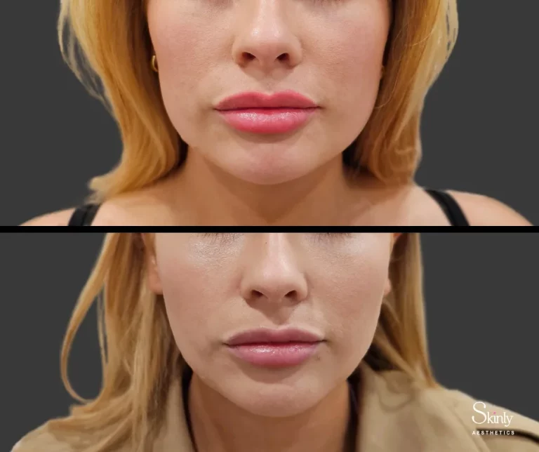Before and after Botox for masseter muscles, showing slimmed jawline