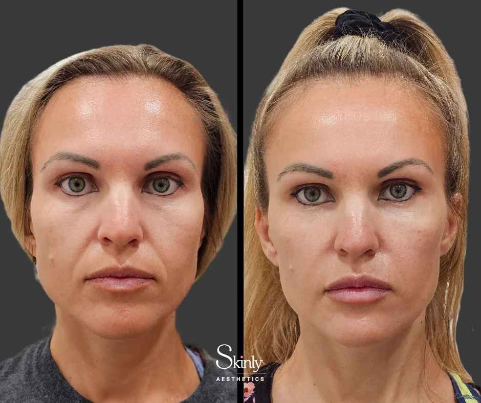 Jawline slimming with masseter botox injections NYC