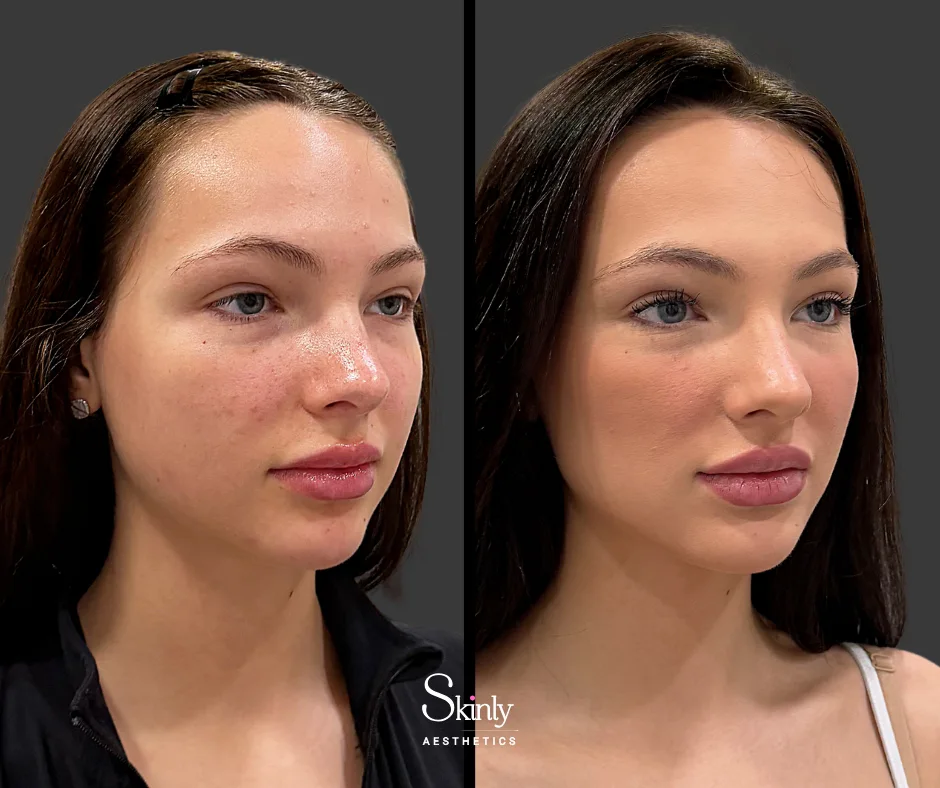 Masseter botox before and after results in NYC