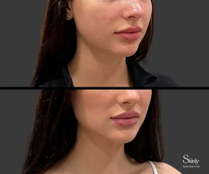 Before and after Botox for masseters.