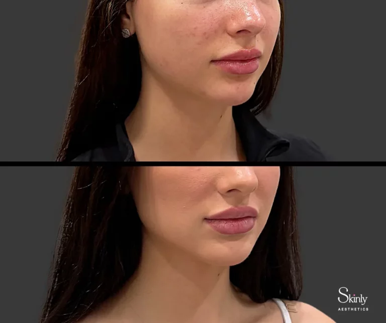 Before and after Botox for masseters.
