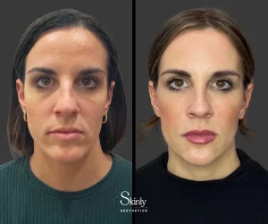Before and after midface filler, restoring volume in the midface.