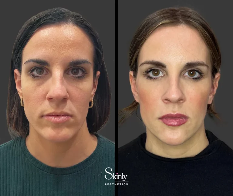 Before and after midface filler, restoring volume in the midface.