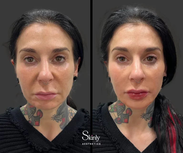Before and after nasolabial fold correction, showing smoothed midface.
