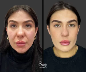 Before and after nasolabial fold filler, showing smooth smile lines.