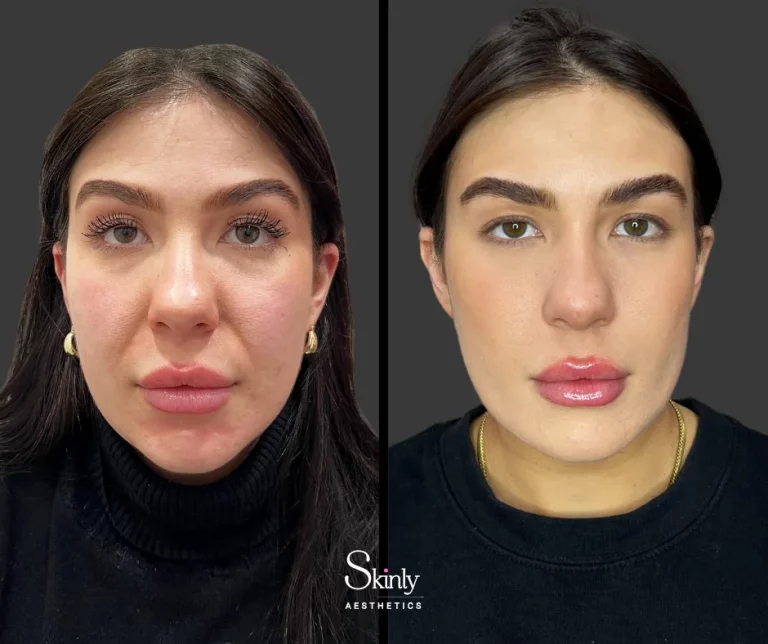 Before and after nasolabial fold filler, showing smooth smile lines.