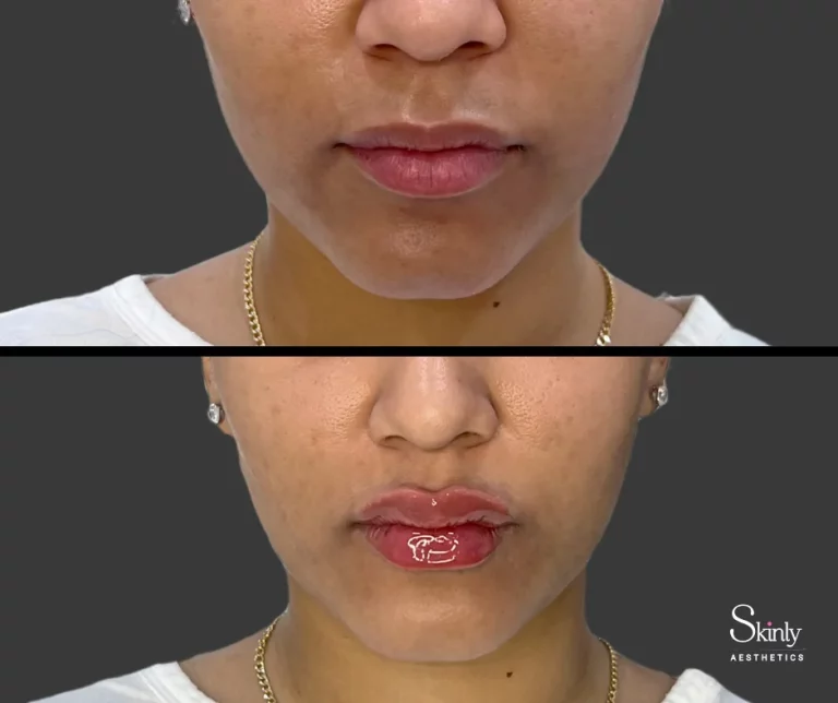 Before and after lip filler showing natural results.