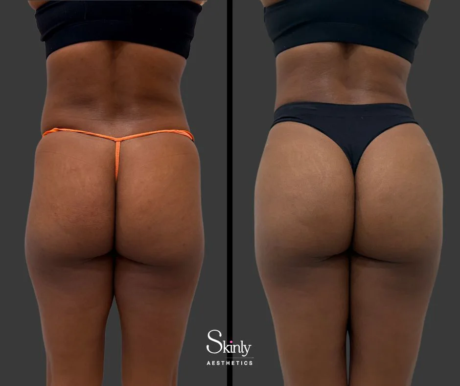 Non-surgical BBL before & after results in NYC