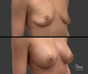 Non-surgical breast enhancement, showing lifted breasts.