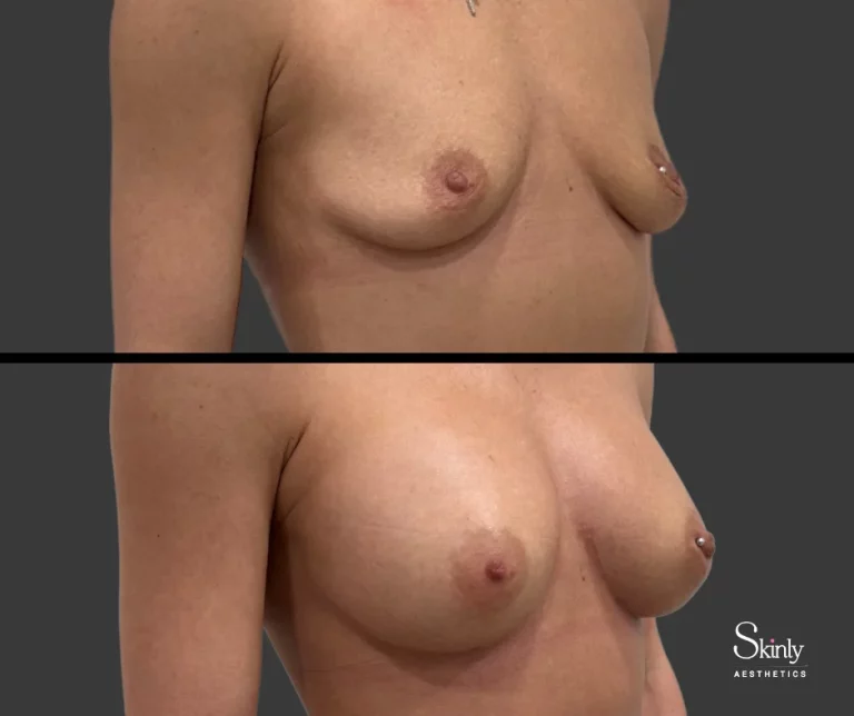 Non-surgical breast enhancement, showing lifted breasts.