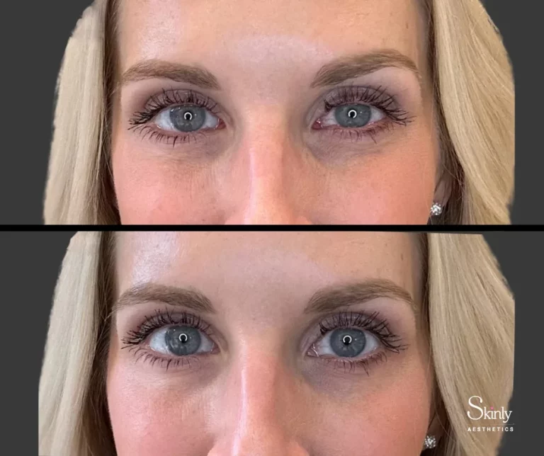 Before and after Upneeq, showing refreshed appearance.