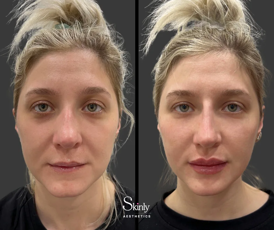 Non-surgical facelift before and after results by Dr. Schwarzburg