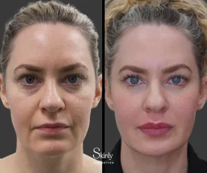 Before and after non-surgical facelift showing rejuvenated appearance.