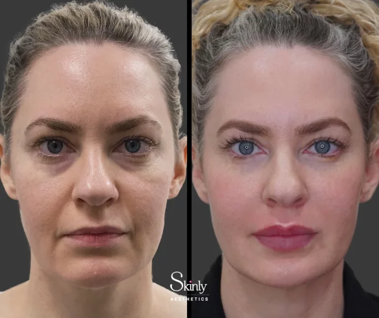 Before and after non-surgical facelift showing rejuvenated appearance.