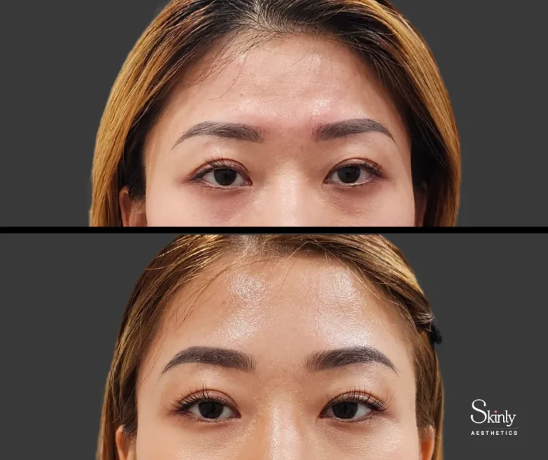 Before and after forehead filler, showing rejuvenated forehead.