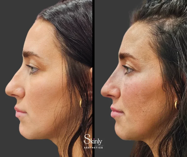 Before and after non-surgical rhinoplasty, showing symmetrical profile.