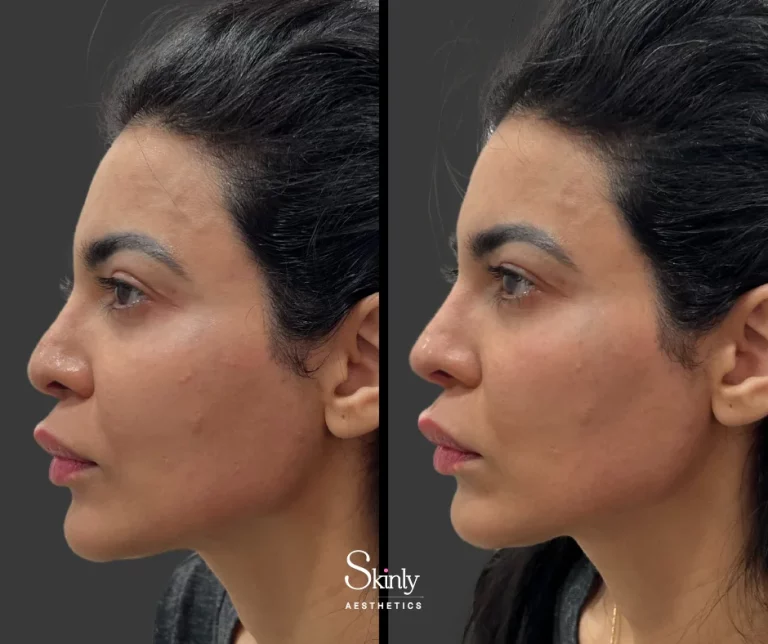 Before and after liquid rhinoplasty, showing a straighter, more defined profile.