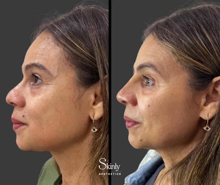 Before and after non-surgical nose job, showing balanced nasal proportions.