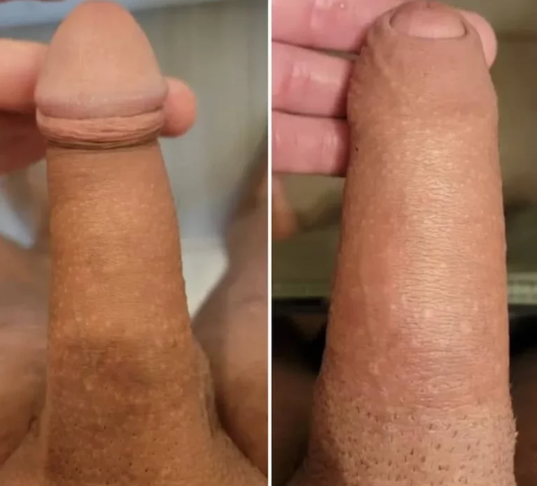 Before and after non-surgical penile enlargement with dermal filler.