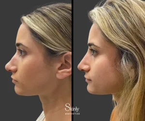 Before and after non-surgical rhinoplasty, showing straightened nasal bridge.