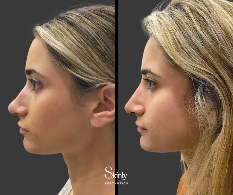 Before and after non-surgical rhinoplasty, showing straightened nasal bridge.