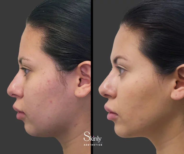 Before and after nose filler, showing straightened bridge.