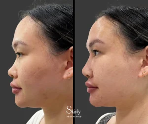 Before and after nose tip filler, showing improved tip projection.
