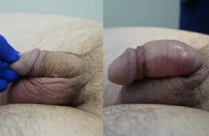 Before and after penile augmentation with filler, showing improved proportion.