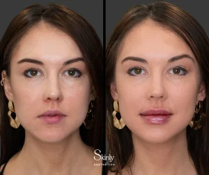 Before and after Russian lip filler, showing enhanced cupid’s bow definition.