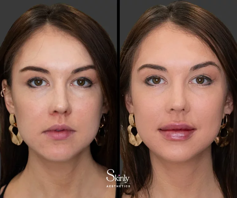 Before and after Russian lip filler, showing enhanced cupid’s bow definition.