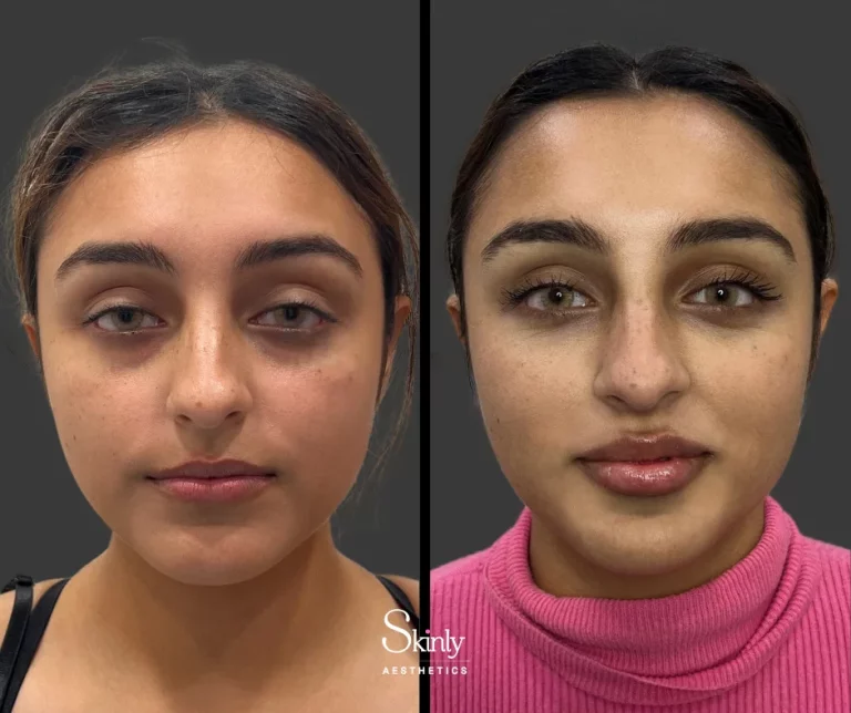 Before and after Russian lip augmentation showing fuller, more symmetrical lips.