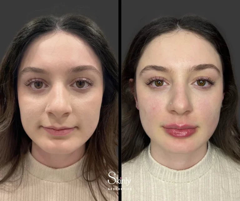 Before and after Russian lip filler, showing improved definition.