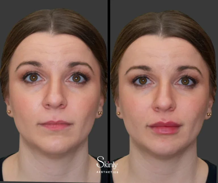 Before and after Russian lip filler, showing natural-looking lip results.