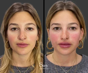 Before and after Russian lip enhancement, showing rejuvenated, smooth lips.