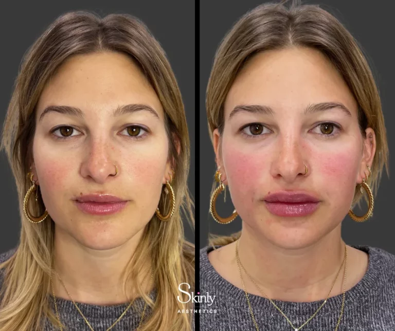 Before and after Russian lip enhancement, showing rejuvenated, smooth lips.