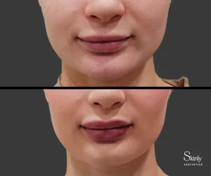 Before and after Russian lip technique, showing increased lip plumpness.