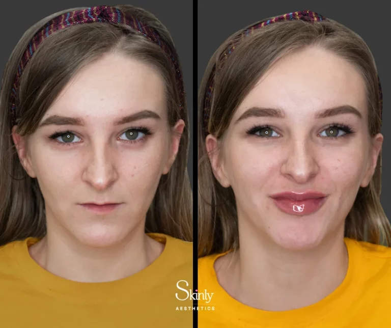 Before and after Russian lip technique, showing natural fullness in the lips.