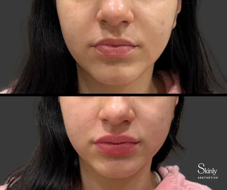 Russian lip filler before and after, showing more attractive lip shape.