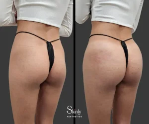 Before and after Sculptra butt augmentation showing round gluteal shape