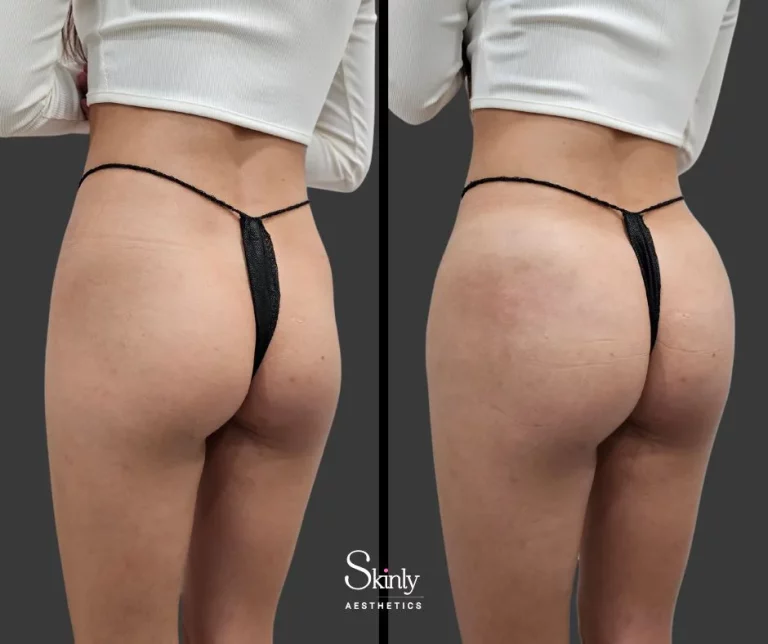 Before and after Sculptra butt augmentation showing round gluteal shape