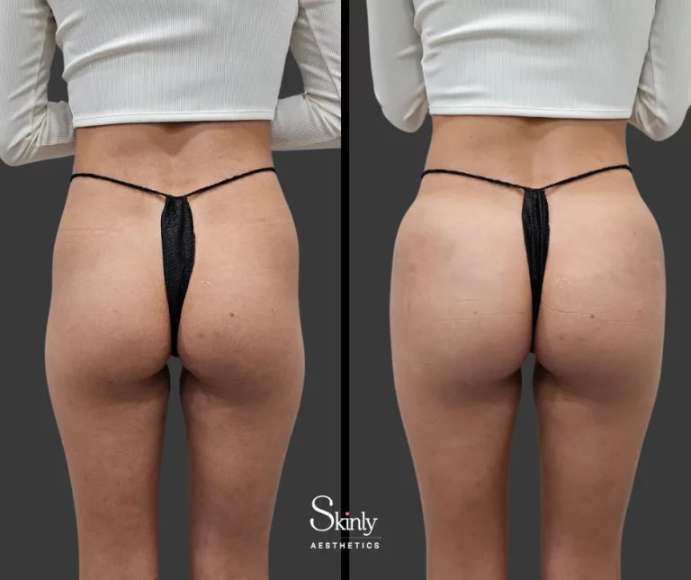 Before and after Sculptra butt lift to enhance buttocks shape.