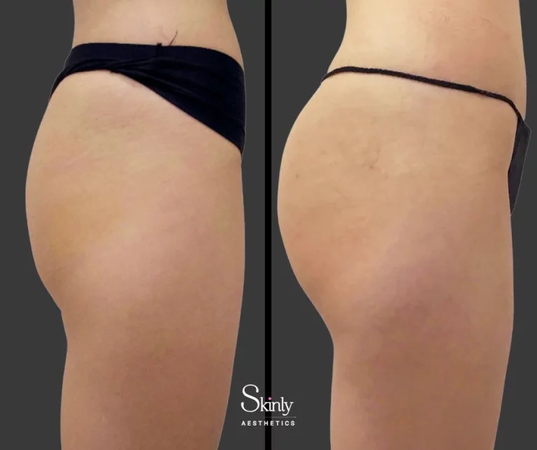 Side view before and after Sculptra butt lift showing projection increase.