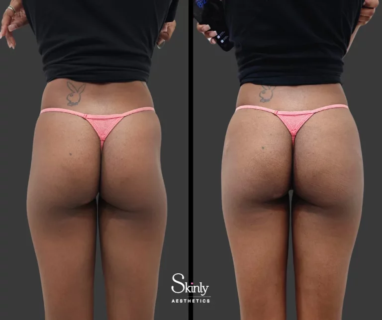 Before and after Sculptra hip dip augmentation showing added hip volume.