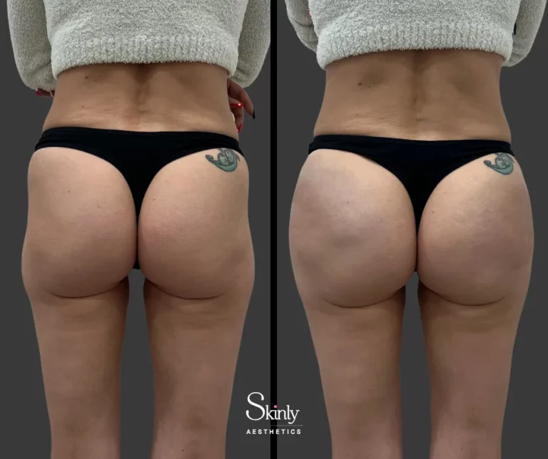 Before and after Sculptra hip dip correction showing natural curve restoration.